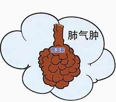 普洱茶治肺气肿怎么喝好一点，怎样正确饮用普洱茶以改善肺气肿症状？