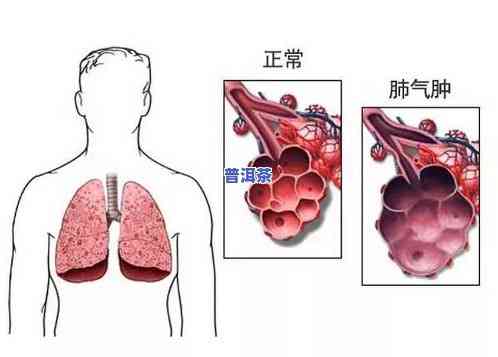 普洱茶对肺气肿的治疗效果怎样？它是不是对肺有益？