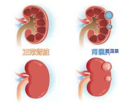 左肾囊肿喝普洱茶可以吗，询问是不是可以采用普洱茶治疗左肾囊肿