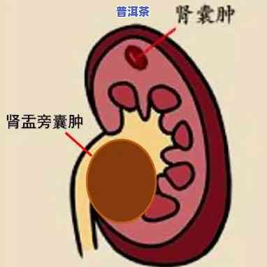 左肾囊肿喝普洱茶可以吗，询问是不是可以采用普洱茶治疗左肾囊肿