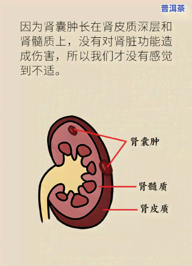 左肾囊肿喝普洱茶真的有效吗？男女通用的答案