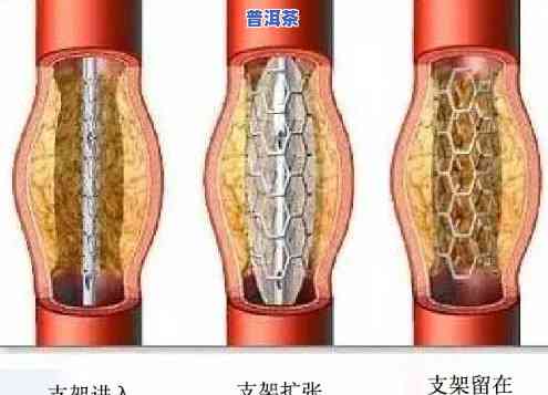 心脏支架手术后能否饮用普洱茶？术后女性患者适用吗？