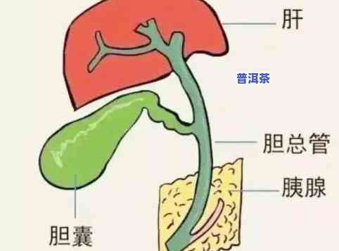 胆囊切除的人可以喝茶叶吗？女性适用吗？