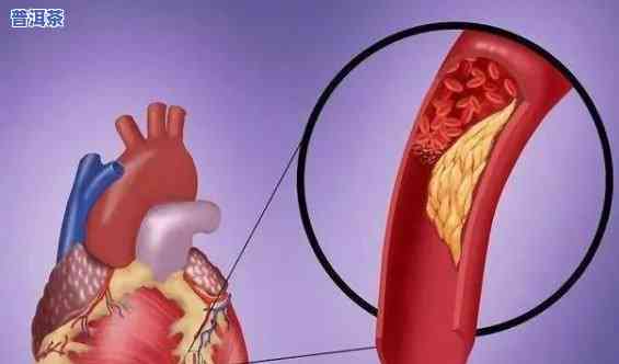 冠脉痉挛后可以喝普洱茶吗，冠脉痉挛后是不是适合饮用普洱茶？